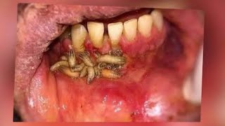 Oral maggots worms in the mouth  oral myiasis  treatment [upl. by Stewart]