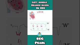 LBBB Left Bundle Branch Block on ECG  quick mnemonic for USMLE NEET PG INICET NCLEX mednotes [upl. by Ttevi]