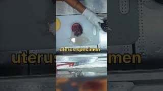 Uterus specimen grossing tissuefixation kidneydisorder cystickidneydisease [upl. by Zasuwa]