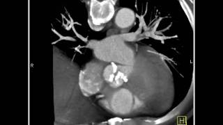 4D Imaging of the Aortic Valve Aortic valve 3 of 3 [upl. by Cohberg]