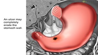 How Stomach Ulcers Form Animation  Peptic Ulcer Disease Causes Symptoms and Treatments Video [upl. by Amalberga]