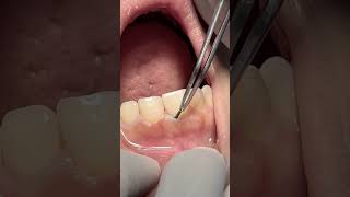 Retraction cord dentist satisfying [upl. by Edac]