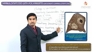 Granulomatosis with polyangiitis  Wegeners granulomatosis  Usmle step 1 vascular Pathology [upl. by Kulsrud]