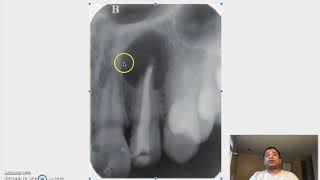 Radiographic Interpretation Part 2  CU Dental Interview Prep [upl. by Inalak816]