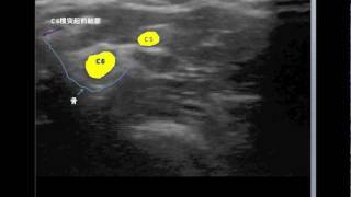 C5C6 cervical nerve root blocks [upl. by Damita]