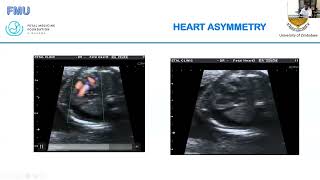 Fetal Echocardiography The Basics  Dr Verenga [upl. by Adnala]