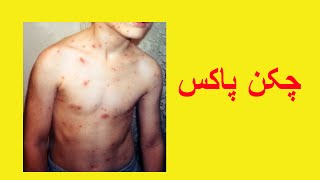 Chicken Pox Information in Urdu [upl. by Verlie652]