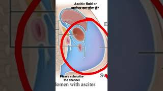 ascitic fluid ascitic asciticfluid jalodhar cannulation [upl. by Jammal]