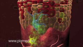 3D MEDICAL ANIMATION Actinic Keratosis  Pixmed [upl. by Luy]