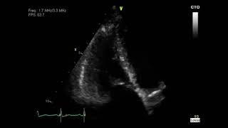 Carcinoid Syndrome [upl. by Whitman]