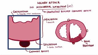 Heart attack acute myocardial infarction causes symptoms diagnosis treatment pathology [upl. by Eimmot822]