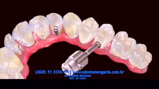 Implantes Dentários  Odontologia Dr Rogério Mengarda [upl. by Dorinda]