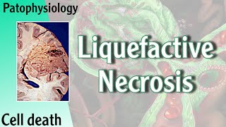 Pathophysiology  Liquefactive Necrosis Hani Laith شرح [upl. by Winograd]