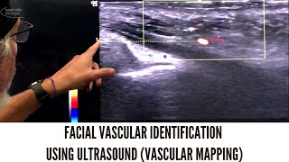 Facial Vascular Identification Using Ultrasound Vascular Mapping [upl. by Zenger]