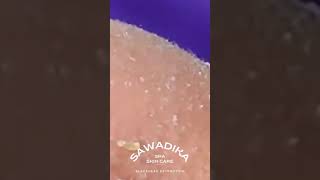 NOSE BLACK heads Tweezers Removal  Satisfying blackheads extraction Shorts 2 [upl. by Ydoc131]