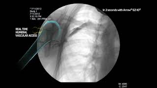 Arrow® EZIO® System  Proximal Humerus Infusion Fluoroscopy Adult Alert Patient [upl. by Jennie]