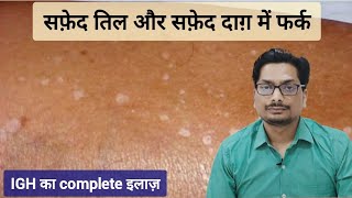 सफ़ेद तिल और सफ़ेद दाग़ में फर्क  Idiopathic Guttate Hypomelanosis  IGH vs Vitiligo vitiligo igh [upl. by Estevan438]