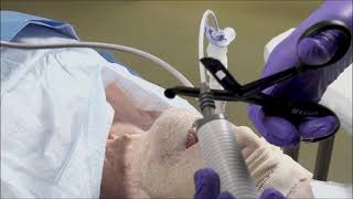 Flexible bronchoscopeguided endotracheal intubation via an igel [upl. by Eriam]