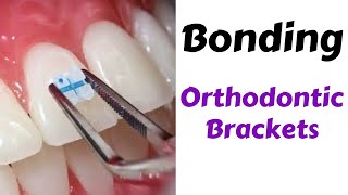 Step by Step Orthodontic Brackets Bonding Technique MBT  orthodontic lecture [upl. by Noyk767]