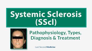 Systemic Sclerosis SScl  Scleroderma  Types Pathophysiology Diagnosis amp Treatment of SScl [upl. by Nonaihr576]