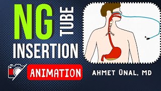 NG Nasogastric TUBE INSERTION  ANIMATION [upl. by Kerri313]