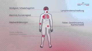 Symptome bei Lymphomerkrankungen [upl. by Iormina15]