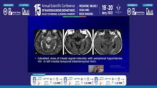 Imaging of Perineural Spread in Pediatric Head and Neck Cancer [upl. by Farrish]