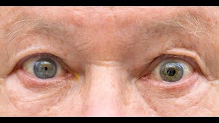 Anisocoria  Symptoms and Causes  Diagnosis  Treatment  Prevention [upl. by Yllitnahc914]