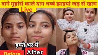 दाने मुहांसे pigmenatiton काले दागधब्बे सेacne scars झाइयां जड़ से खत्म करे मुल्तानी मिट्टीऐसे लगाए [upl. by Butterworth]