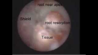 External Root Resorption 2 Viewed with the Perioscope [upl. by Adnicul]