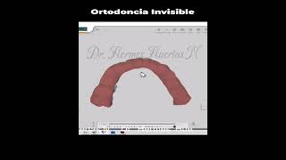 Titan Ortodoncia Invisible [upl. by Leruj]