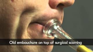 Trumpet embouchure before and after surgery [upl. by Sabine443]