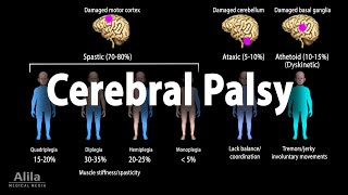 Cerebral Palsy Animation [upl. by Sjoberg]