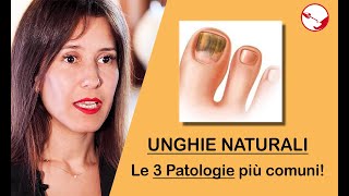 3 di 5  PATOLOGIE UNGHIE  Onicolisi Onicomicosi amp Infezione batterica 3 patologie più comuni [upl. by Hnao375]