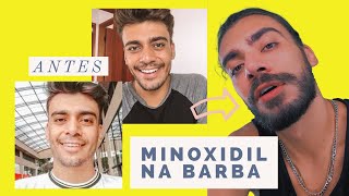 MINOXIDIL NA BARBA COMO USAR  ANTES E DEPOIS  ALEX CURSINO [upl. by Regnig958]