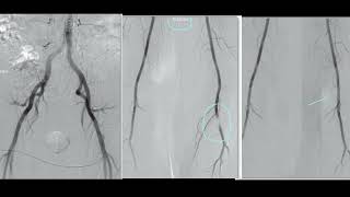 Catheter Angiogram of the Lower Limbs Identifying Popliteal Artery Anomalies FRCR2B [upl. by Tandy]