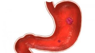 Peptic Ulcers Symptoms Causes Diagnosis and Treatments  Health and life [upl. by Karel227]