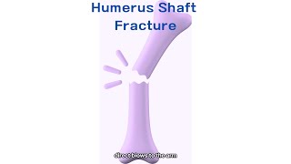 Humerus Shaft Fracture  Cause and Management [upl. by Helli796]