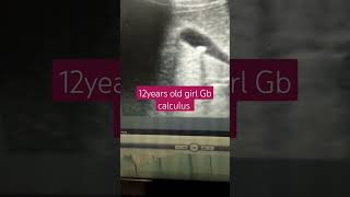 gallstones 12 years old girl cholelithiasis [upl. by Nnylanna]