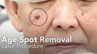 Laser Keratosis Removal  Cosmetic Medical Clinic CMC NSW [upl. by Ozkum439]