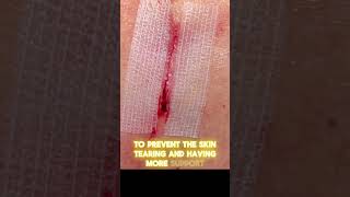 Using steristrips to prevent scars [upl. by Xenos]