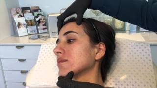 Dermapen Skin Needling for Acne amp Scarring [upl. by Caldeira]