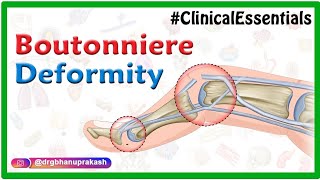 Boutonnière Deformity Swan neck Deformity Elson test Mallet finger  Animated Clinical essentials [upl. by Sarena]