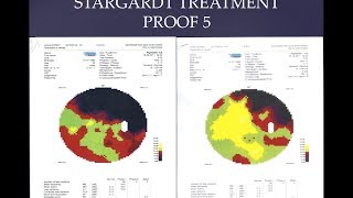 Stargardt Disease Treatment Proof 5 FIRATLI CLINIC [upl. by Akilat996]