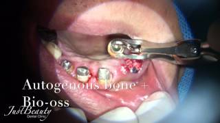 Guided surgery  Immediate implant placement with a flapless approach in aesthetic zone [upl. by Boswall4]