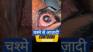 चश्मे से आज़ादी Contoura Vision के साथ [upl. by Notsla747]