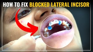 How to FIX Blocked Lateral Incisor StepbyStep Orthodontic Guide by Dr Kapil Saroha [upl. by Sharpe]