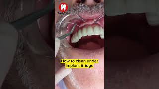 How to floss under Implant Bridge with superfloss flossing dentalcare dentalimplants shorts [upl. by Falo]