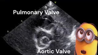 Uni cuspid Aortic valve echocardiography [upl. by Yduj]