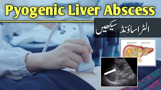 Pyogenic Liver Abscess in Ultrasound by Dr Ali Waqar [upl. by Eirrehc]